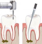 ۵ سوال اساسی در مورد عصب کشی دندان
