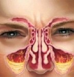 خطر ابتلا به پولیپ بینی و سینوزیت برای مبتلایان به آلرژی