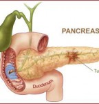 نشانه ها و درمان سرطان پانکراس